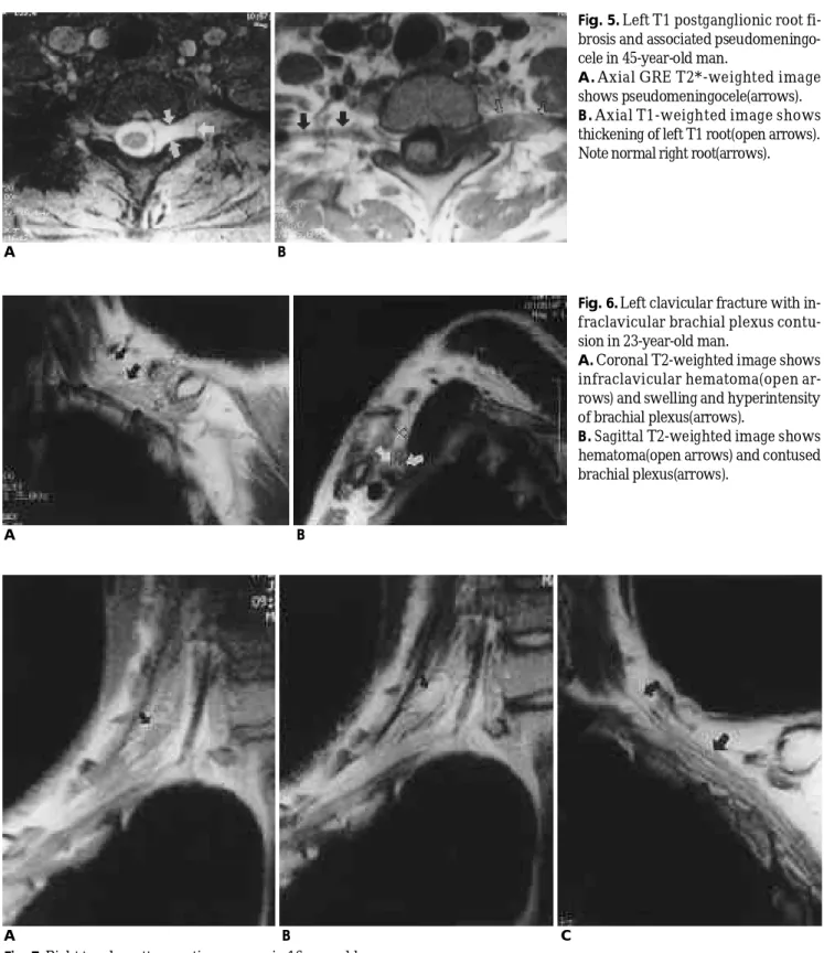 Fig. 5. Left T1 postganglionic root fi- fi-brosis and associated  pseudomeningo-cele in 45-year-old man.
