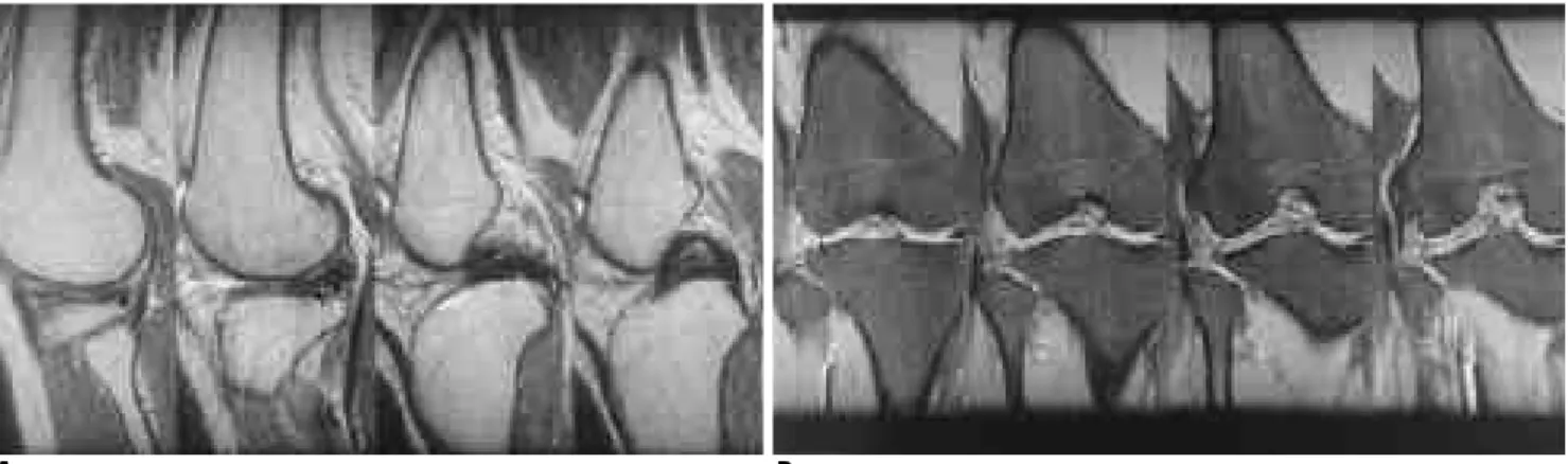 Fig. 4. False positive case: Peripheral tear in lateral discoid meniscus. 