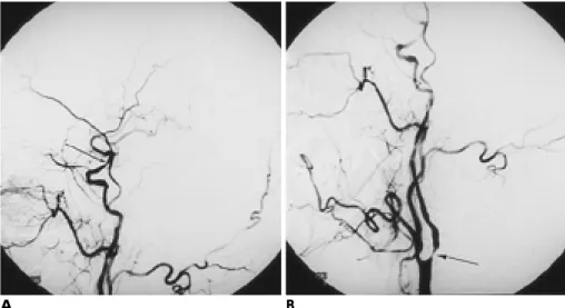 Table 1. Distribution of Severe Stenosis