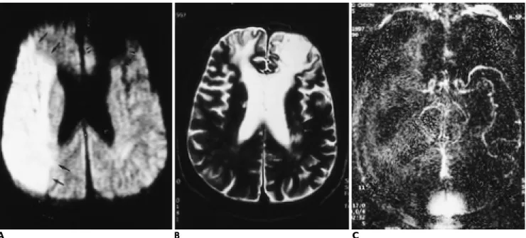 Fig. 1. Two hours old infarct. 