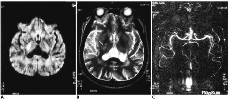 Fig. 2. One-day old infarct. 