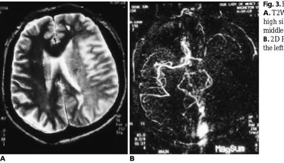 Fig. 3. Fifteen hours old infarct. 