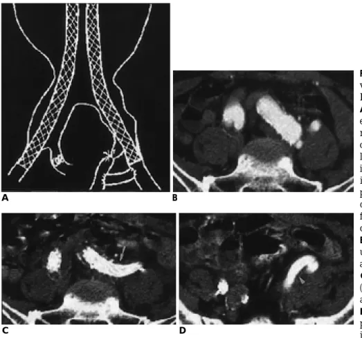 Fig. 2. A 72-year-old man with AAA in- in-voliving bilateral iliac bifurcation (type D ) .