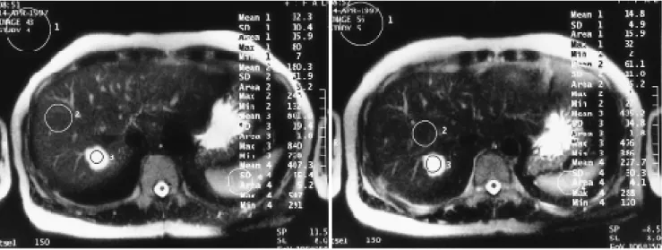 Fig. 2. An example of hepatic hemangioma on a HASTE sequence with TE 90 msec (A) and TE 134 msec (B)