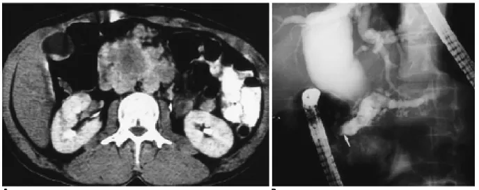 Fig. 1. A 65-old-year man with chronic pancreatitis.