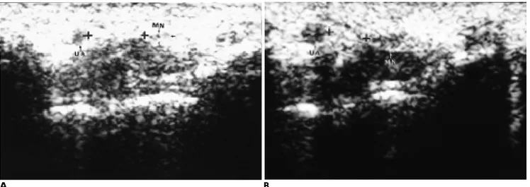 Fig. 6. Transverse sliding of median nerve in a 38-year-old woman with normal control