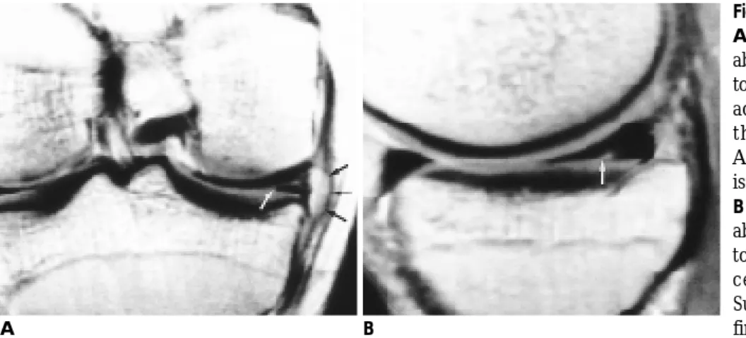Fig. 1. Coronal fast spin-echo(FSE) image(TR/TE=3500/16) shows abnormal signal intensity within the body of the medial meniscus