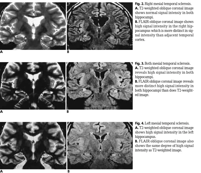 Fig. 3. Both mesial temporal sclerosis.