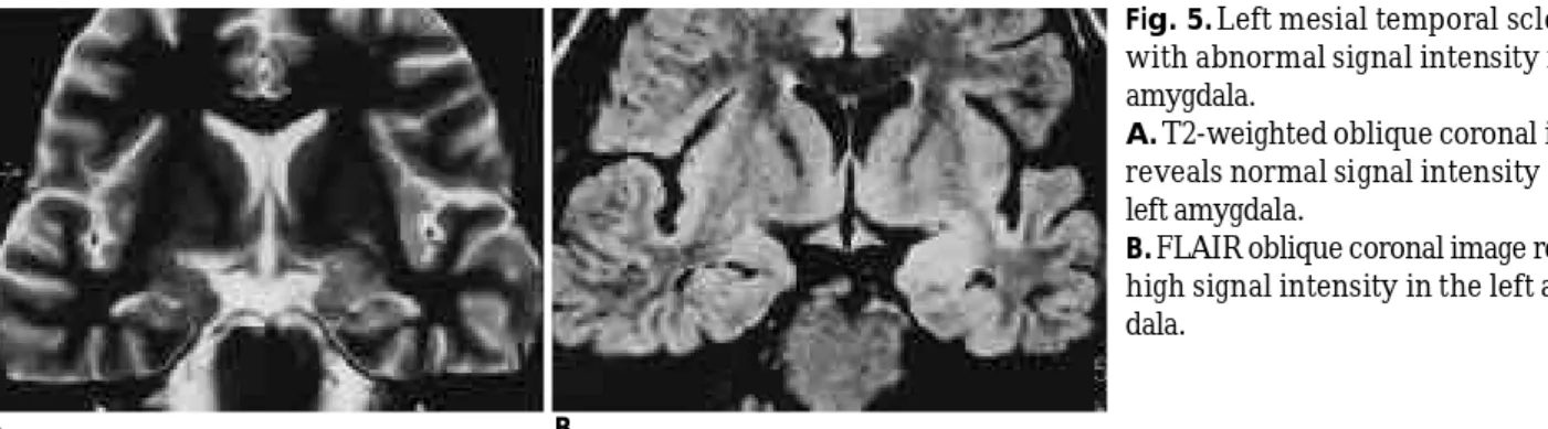 Fig. 5. Left mesial temporal sclerosis with abnormal signal intensity in the a m y g d a l a .