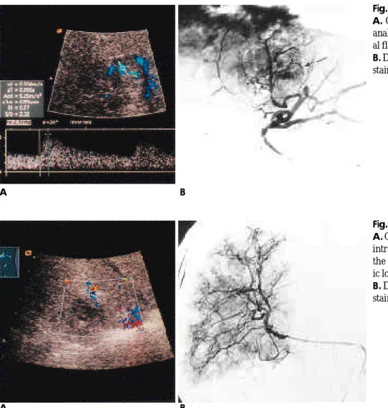Fig. 1. Hypervascular HCC after TACE A. Color Doppler US with spectral analysis demonstrates a pulsatile  arteri-al flow within the lesion.