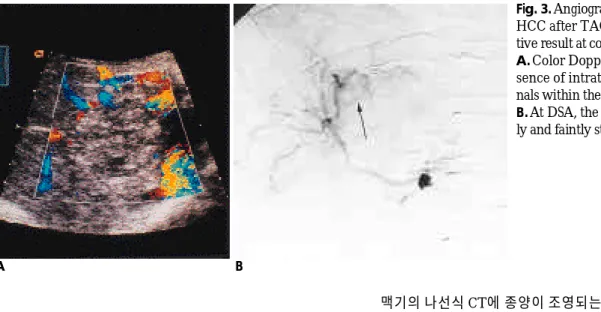Fig. 3. Angiographically hypervascular HCC after TACE showing false  nega-tive result at color Doppler US A