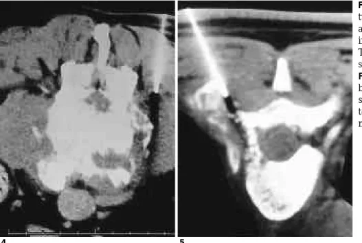 Fig. 5. In 30 year-old woman with back pain and lower leg weakness, CT scan shows soft tissue mass in left  pos-terior compartment of T4