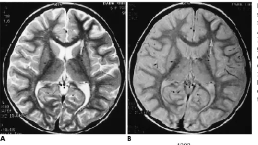 Fig. 1. Type I lesion. Asymmetrical low signal intensity of subcortical white m a t t e r .