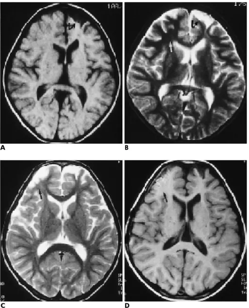 Fig. 2. MR image shows changing of le- le-sion from type I to type II.