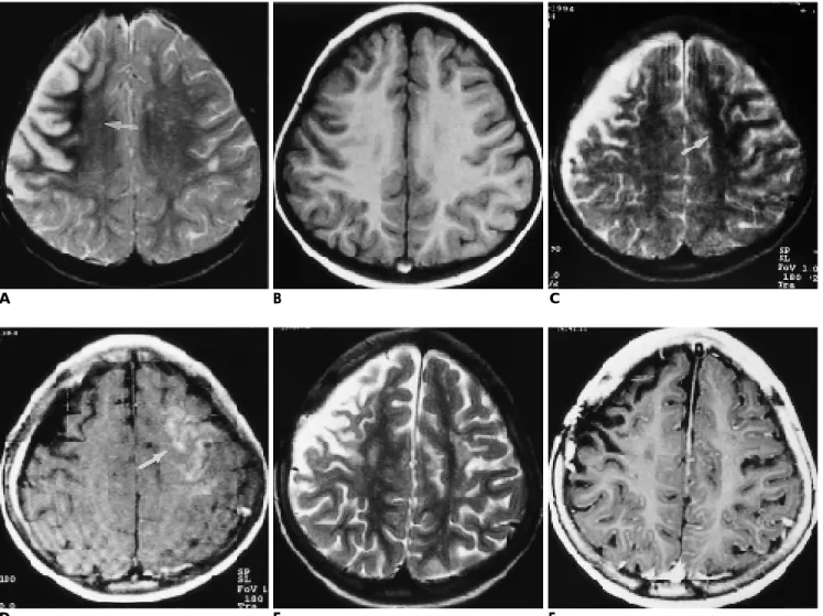 Fig. 3. MR image shows changing types from I to III lesion and normalized type I lesion after surgical intervention.