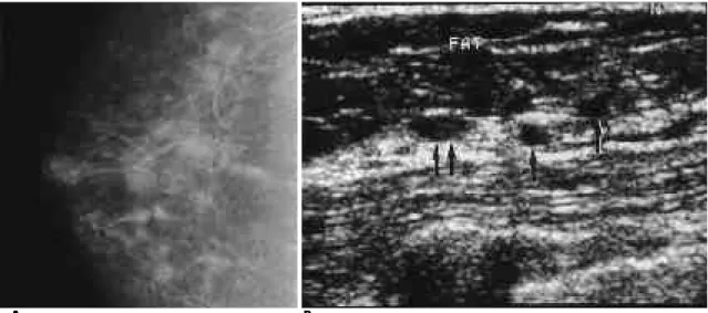 Fig. 3. A 70-year-old woman with a history of bloody nipple discharge. Pathologic diagnosis through selective duct excision was ductal carcinoma in situ (cribriform and micropapillary type).