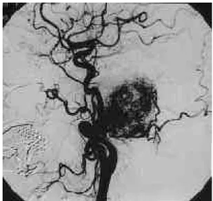Fig. 3. Left common carotid angiogram