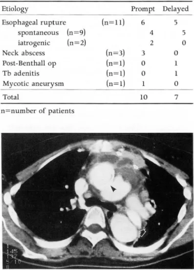 Table  1.  Causes of Mediastinitis  and  Timing of Diagnosis 