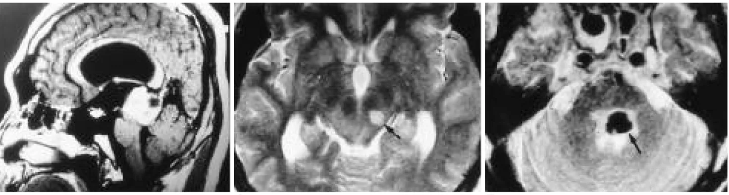Fig. 5. Vertical gaze palsy caused by pineal germinoma (Parinaud’s syndrome) .Enhanced sagittal T1-weighted MR image shows a well enhanced pineal mass which causes compression of the midbrain resulting in patient’s upgaze palsy.