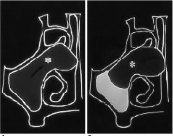 Fig. 2. Prolapsed antral mucosa. 