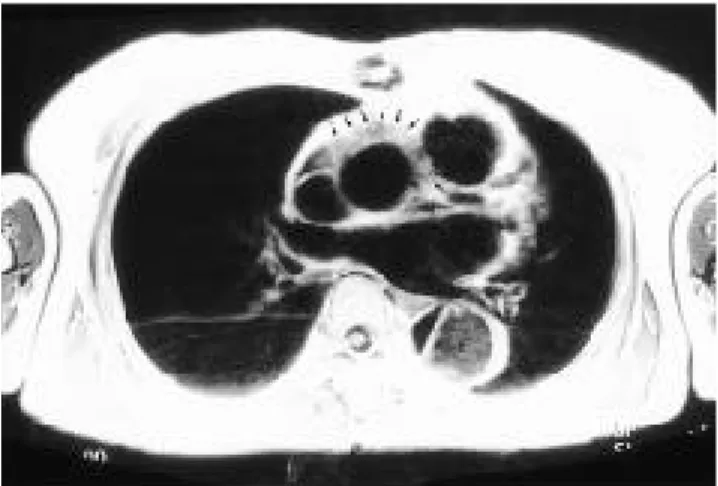 Fig. 2. A. Preoperative contrast-enhanced CT scan at the level of interventricular septum shows aortic dissection complicated with hemothorax (open arrows) and hemopericardium (solid arrows)
