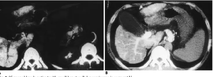 Fig. 1. 35-year-old male patient with small hepatocellular carcinoma in segment V. 