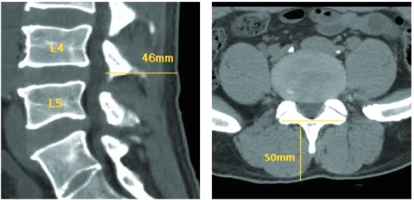 Fig. 2. Actual length from the surface of the skin to ligamenta flava and spinal cord.