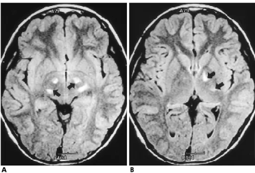Fig. 4. A asymptomatic 12-year-old boy with adrenoleukodystrophy.