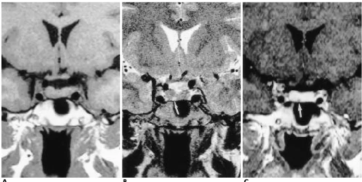 Fig. 1. A 38-year-old woman with pituitary microadenoma.