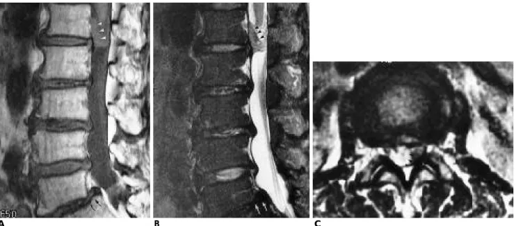 Fig. 4. 53-year-old female with back pain and radiating pain.