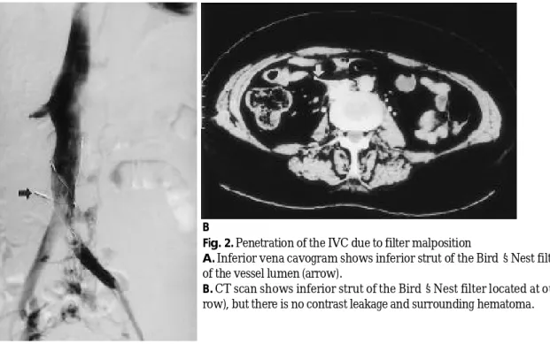 Fig. 3. Prolapse of filter wire