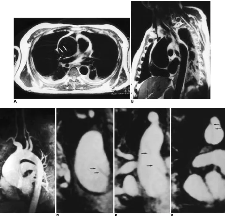 Fig. 1. A 40-year-old man with DeBakey type I aortic dissection.