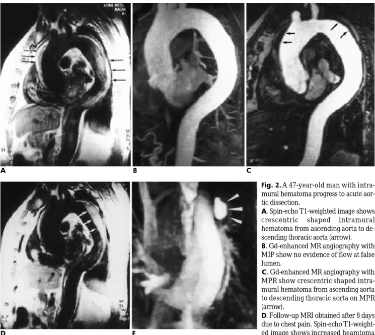 Fig. 2. A 47-year-old man with intra- intra-mural hematoma progress to acute  aor-tic dissection.