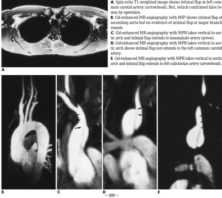 Fig. 3. A 30-year-old man with DeBakey type I aortic dissection.