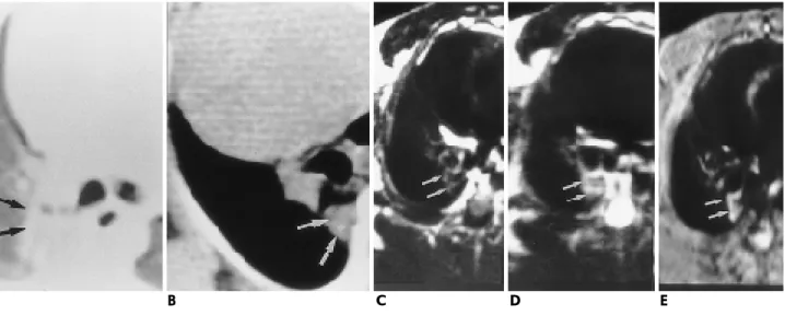 Fig. 4. HRCT, MR scans, and histopathologic findings of the lung with shark liver oil-induced lipoid pneumonia obtained  six-teen weeks after the administration.