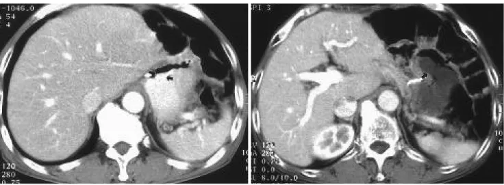 Fig. 3. 46-years old man with subtotal gastrectomy for stomach cancer