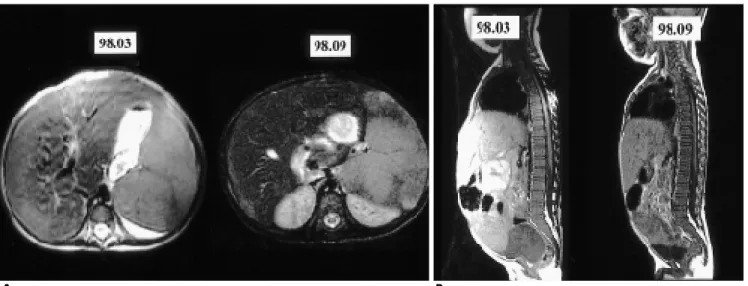 Fig. 2. 30 months old male type I patient. initial and 6 month followup study during enzyme treatment