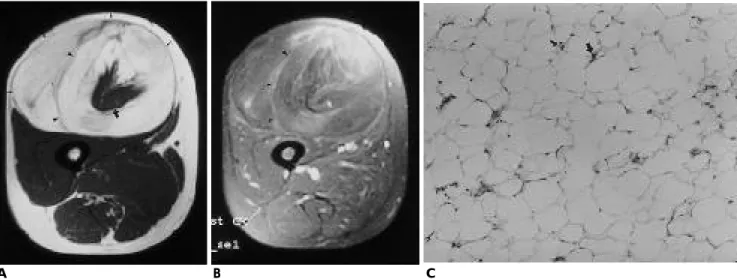 Fig. 1. A 59-year-old woman with well differentiated liposarcoma in the thigh.