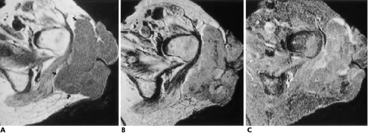 Fig. 5. A 58-year-old woman with pleomorphic liposarcoma in the buttock.