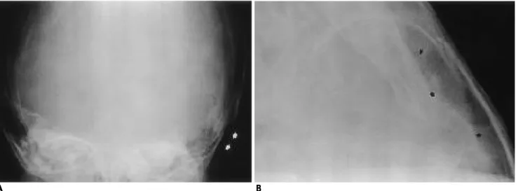 Fig. 2. On CT  scan using  bone  window setting,  soft  tissue mass  in  the  left  temporal  bone  demonstrates erosion  of the outer  table  and  marked  thinning  of  the  inner  table