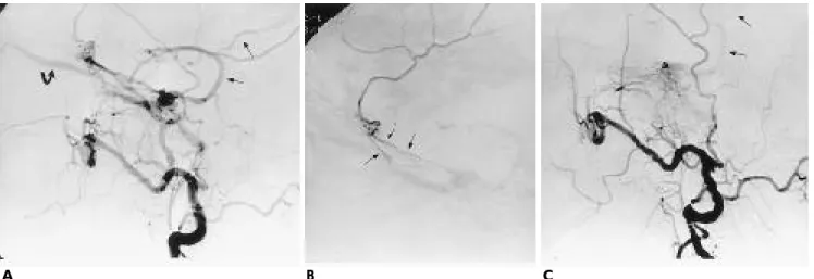 Fig. 1. Transarterial treatment(Case 11). 
