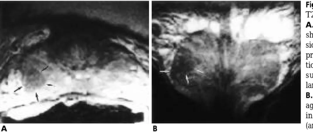 Table 1. Comparison of Prostate Cancer Staging : Endorectal Coil MRI vs Pathology  M R I Pathologic Stage S t a g e T 2 a T 2 b T 2 c T 3 a T 3 b T 3 c T 4 T o t a l T 2 a 1 1 2 T 2 b 1 1 T 2 c 2 1 1 4 T 3 a 1 5 1 7 T 3 b 2 2 T 3 c 4 4 T 4 0 T o t a l 1 2 