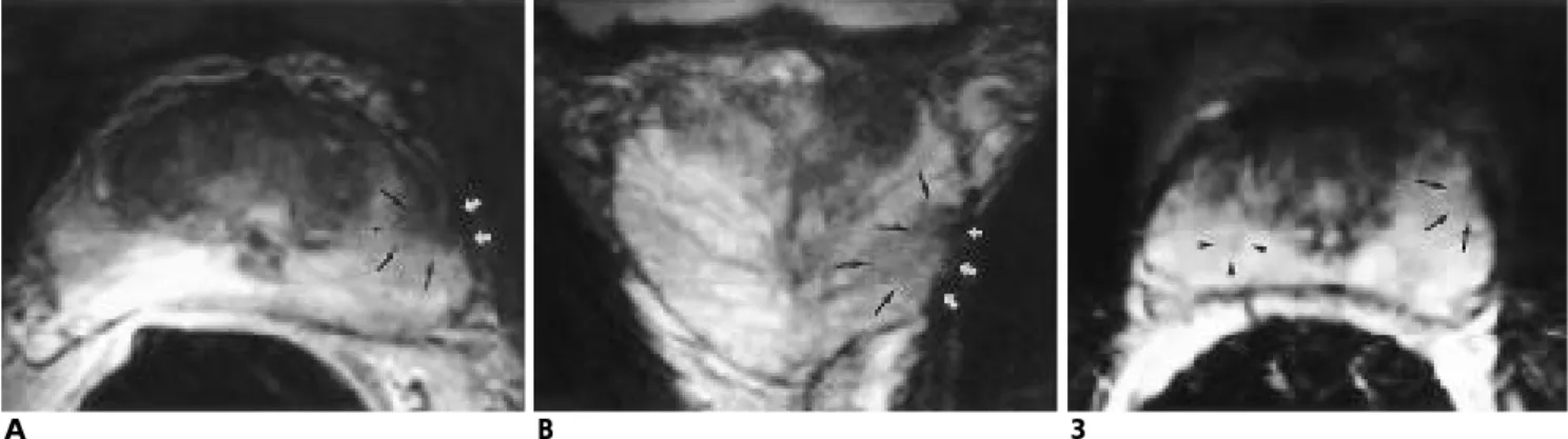 Fig. 4. Biopsy related hemorrhage in the prostate gland. 