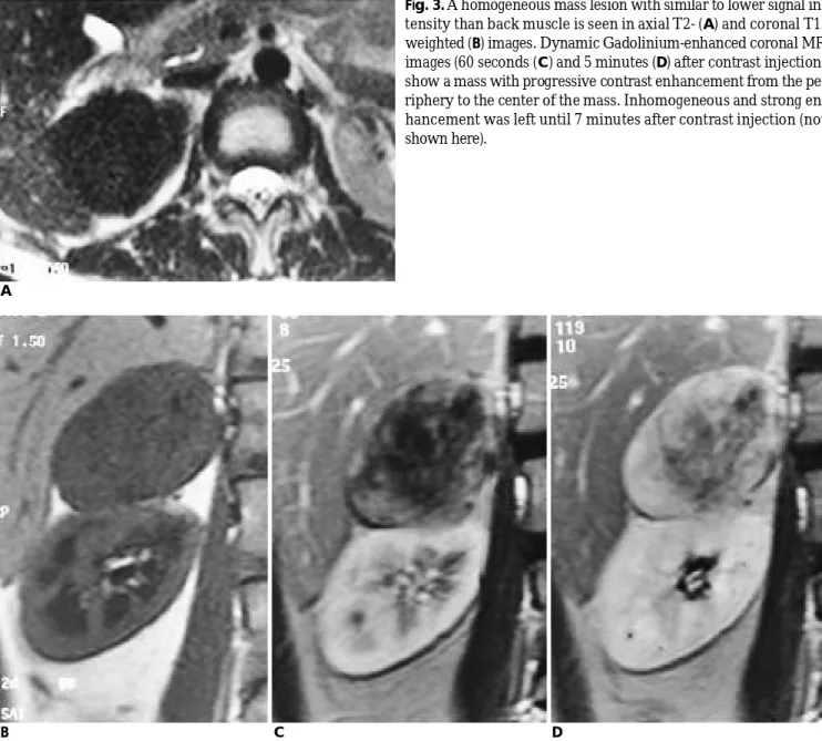Fig. 2. Pre-enhanced CT scan shows a round soft tissue density mass lesion with irregular and rim calcifications (A) and contrast- contrast-enhanced CT scan shows minimal peripheral contrast enhancement (B) .