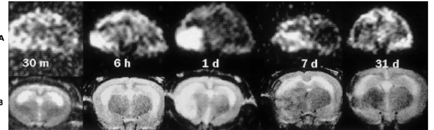 Fig. 1. Serial diffusion-weighted (A) and T2-weighted images (B) after development of infarction