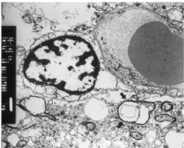 Fig. 4. Electron microscopic finding at 6 hours after infarction onset (×5,000). Neuropils are swollen and have many  vac-uoles