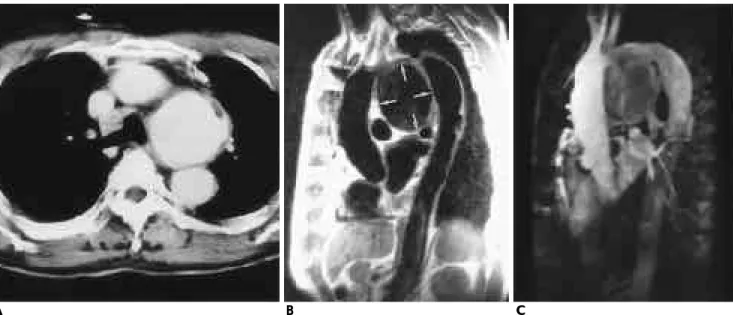 Fig. 3. Saccular form aneurysm in a 74-year-old man.