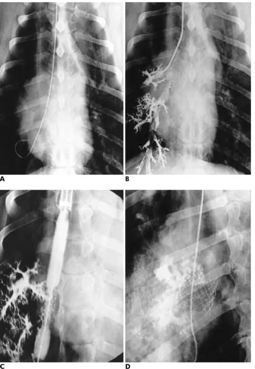 Fig. 4. A-D Stent placement.