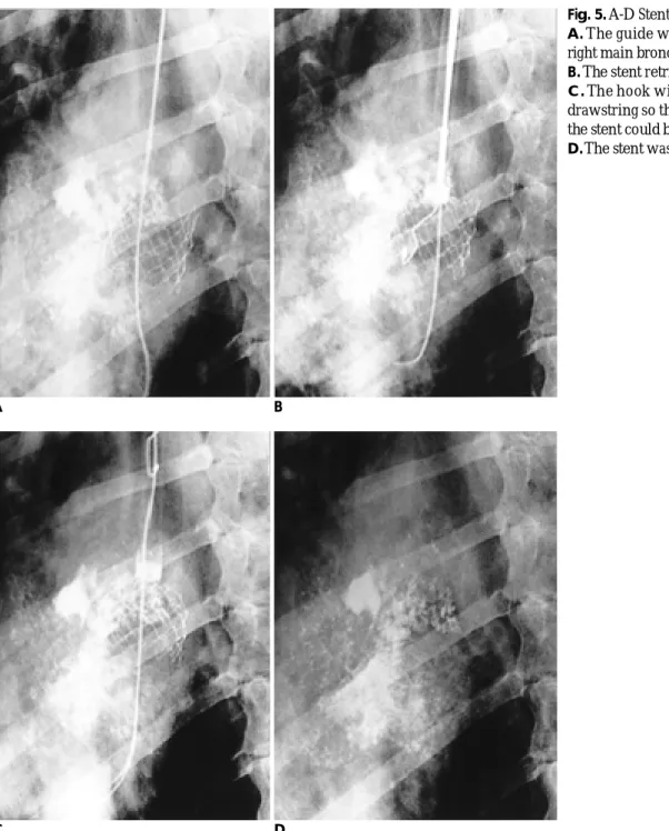 Fig. 5. A-D Stent removal