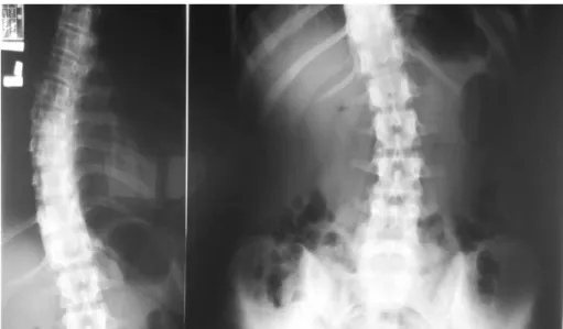 Fig. 3. T-L spine AP (14.01.16).